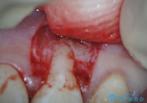 前歯の歯肉退縮 歯周形成外科(歯冠側移動術)の治療中