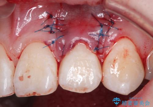 前歯の歯肉退縮 歯周形成外科(歯冠側移動術)の治療中