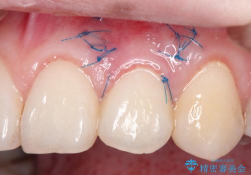 前歯の歯肉退縮　歯周形成外科(歯冠側移動術)の治療中