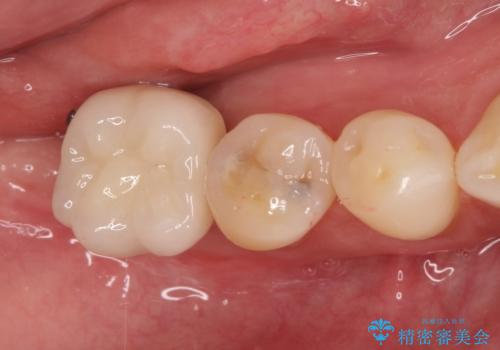奥歯が痛い。抜歯~奥歯のインプラント の治療後