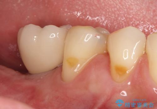 奥歯が痛い。抜歯~奥歯のインプラント の症例 治療後