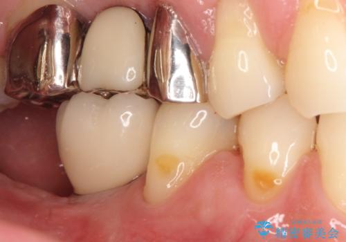 奥歯が痛い。抜歯～奥歯のインプラント　の治療後