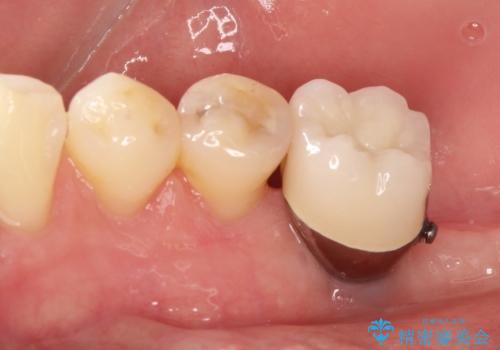奥歯が痛い。抜歯~奥歯のインプラント の治療後