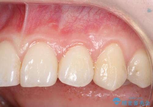 前歯の歯肉退縮 歯周形成外科(歯冠側移動術)の症例 治療後
