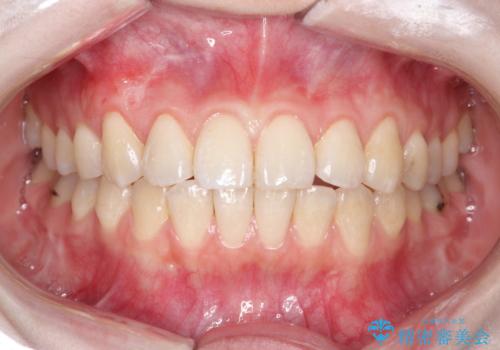前歯の歯肉退縮　歯周形成外科(歯冠側移動術)の治療後