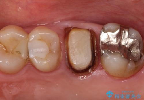 発見の難しい虫歯。根管治療から被せもの治療の治療中