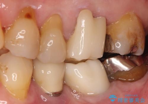 発見の難しい虫歯。根管治療から被せもの治療の治療後