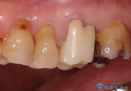 発見の難しい虫歯。根管治療から被せもの治療の治療後