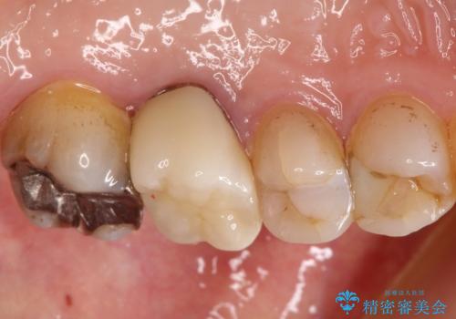 発見の難しい虫歯。根管治療から被せもの治療の症例 治療後