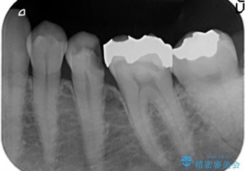 銀歯が外れ、内部に大きな虫歯の再発の治療前