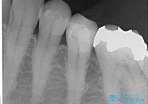 銀歯が外れ、内部に大きな虫歯の再発の治療後