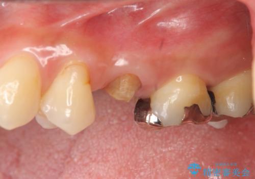 放置し崩壊した歯 セラミック治療による咬合機能回復の治療前