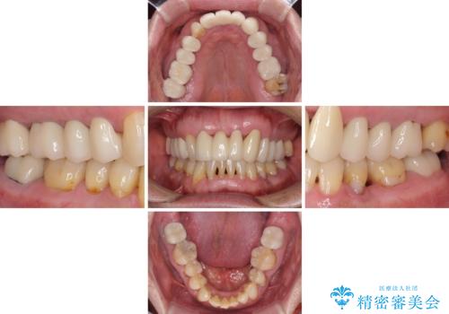矯正治療と歯周外科処置を併用した審美歯科治療の治療後