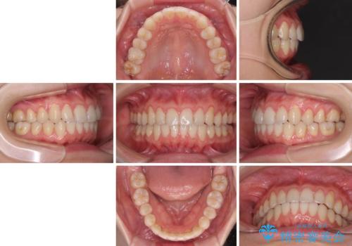 前歯のデコボコを治したい　インビザラインによる矯正治療の治療後