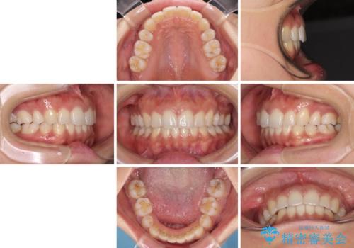 抜歯矯正の後戻り インビザラインによる再矯正治療の治療後
