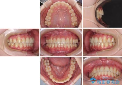 軽度な後戻りをインビザライン・ライトで改善の治療後