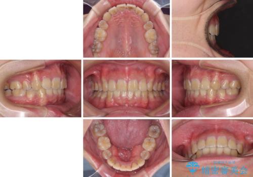 口元の突出感と叢生 ワイヤー装置による抜歯矯正の治療後