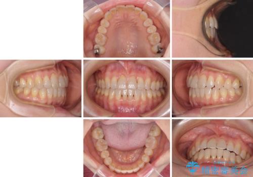 前歯の叢生と切端咬合 インビザラインによる矯正治療の治療後