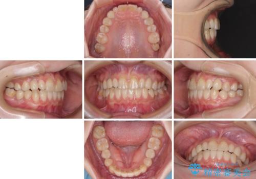 欠損と残存乳歯　矯正治療とインプラント治療の治療後