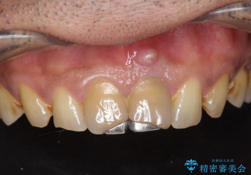 歯ぐきからの出血　膿が出る 前歯根管・セラミック治療の症例 治療前