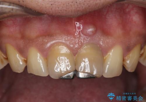 歯ぐきからの出血　膿が出る 前歯根管・セラミック治療の治療前