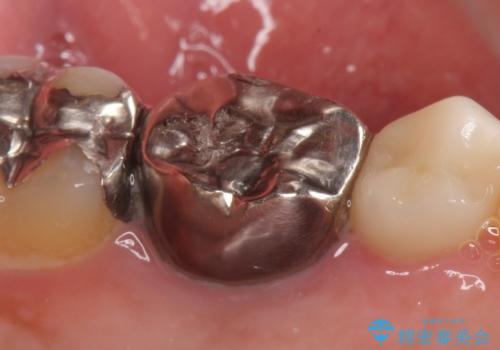 オールセラミッククラウン 銀歯を白くの治療前