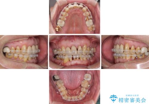 矯正治療と歯周外科処置を併用した審美歯科治療の治療中