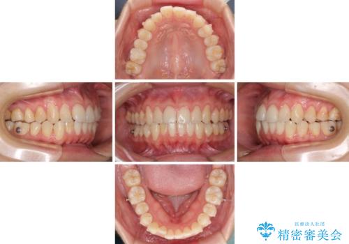 前歯のデコボコを治したい　インビザラインによる矯正治療の治療中