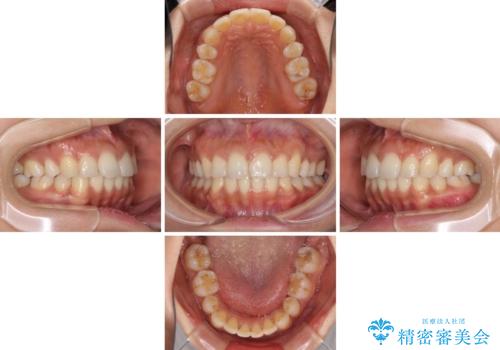 抜歯矯正の後戻り インビザラインによる再矯正治療の治療中