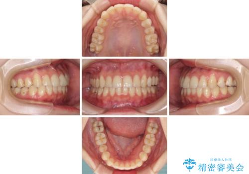 軽度な後戻りをインビザライン・ライトで改善の治療中