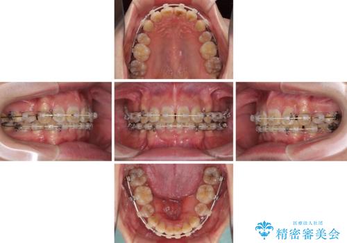 口元の突出感と叢生 ワイヤー装置による抜歯矯正の治療中
