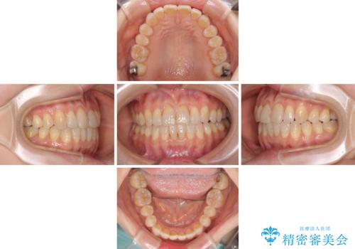 前歯の叢生と切端咬合 インビザラインによる矯正治療の治療中