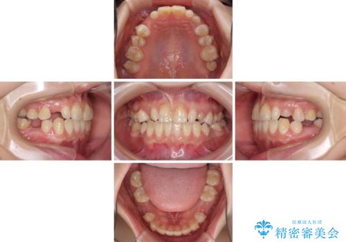 欠損と残存乳歯 矯正治療とインプラント治療の治療中