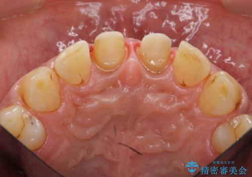 歯ぐきからの出血　膿が出る 前歯根管・セラミック治療の治療中