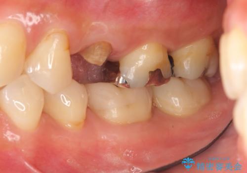 放置し崩壊した歯　セラミック治療による咬合機能回復の治療前