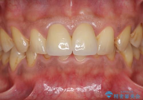 歯ぐきからの出血 膿が出る 前歯根管・セラミック治療の治療後