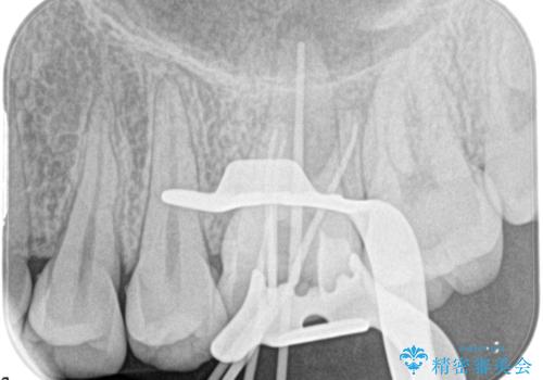 奥歯の根管治療の治療中