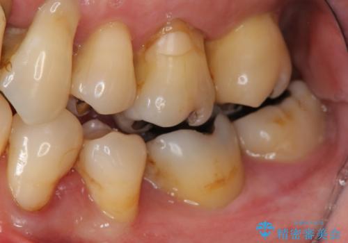 歯周病　インプラントによる咬合機能回復の治療前
