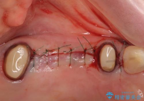 [ 歯牙破折 ]  インプラントによる咬合機能回復の治療中