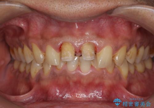 歯ぐきからの出血 膿が出る 前歯根管・セラミック治療の治療中