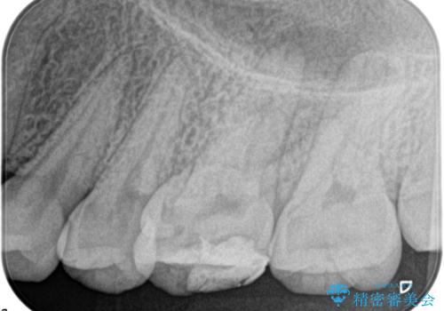 奥歯の根管治療の治療前