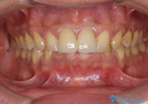 歯ぐきからの出血 膿が出る 前歯根管・セラミック治療の治療後
