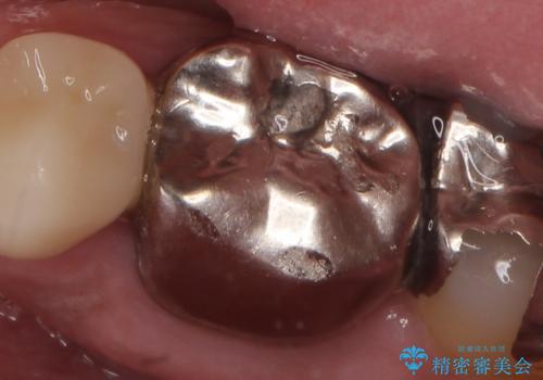 オールセラミッククラウン 銀歯を白くの治療前