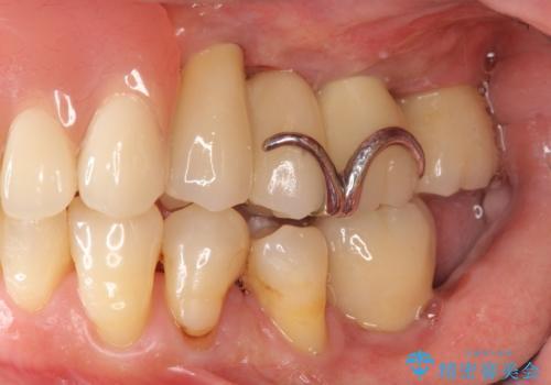 歯周病　インプラントによる咬合機能回復の治療後