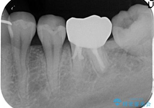 目立つ銀歯を白くしたい セラミック治療の治療後