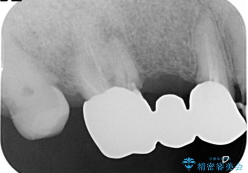 奥歯がなくてかめない 入れ歯とクラウンでの全顎治療の治療前