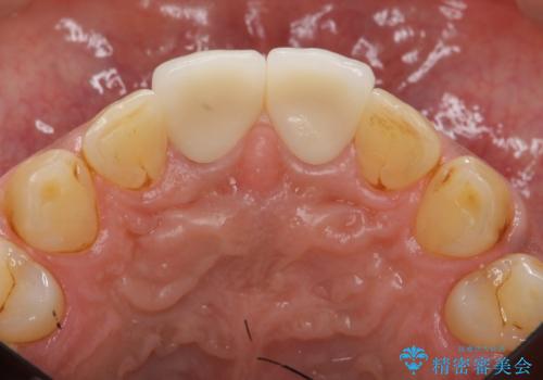 歯ぐきからの出血 膿が出る 前歯根管・セラミック治療の治療後