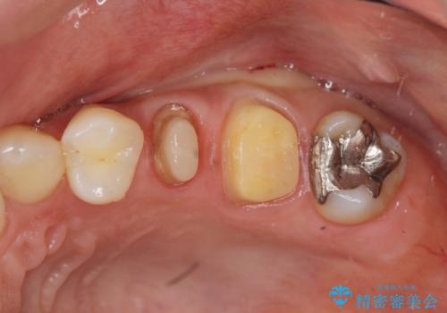 放置し崩壊した歯　セラミック治療による咬合機能回復の治療中