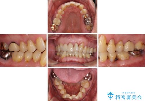 矯正治療と歯周外科処置を併用した審美歯科治療の治療前