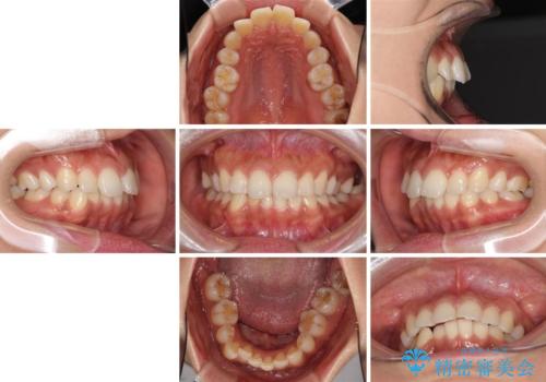 抜歯矯正の後戻り インビザラインによる再矯正治療の治療前